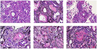 Arterial-Arteriolar Sclerosis Is Independently Associated With Poor Renal Outcome in <mark class="highlighted">IgA Nephropathy</mark> Patients